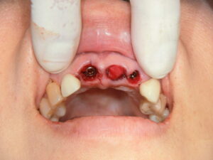 その日に笑顔を取り戻す、即時抜歯荷重