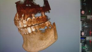 感じ方はそれぞれのインプラント