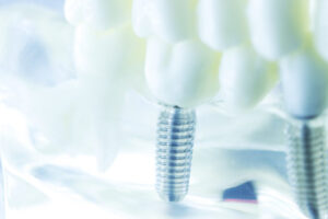 インプラントの上部構造