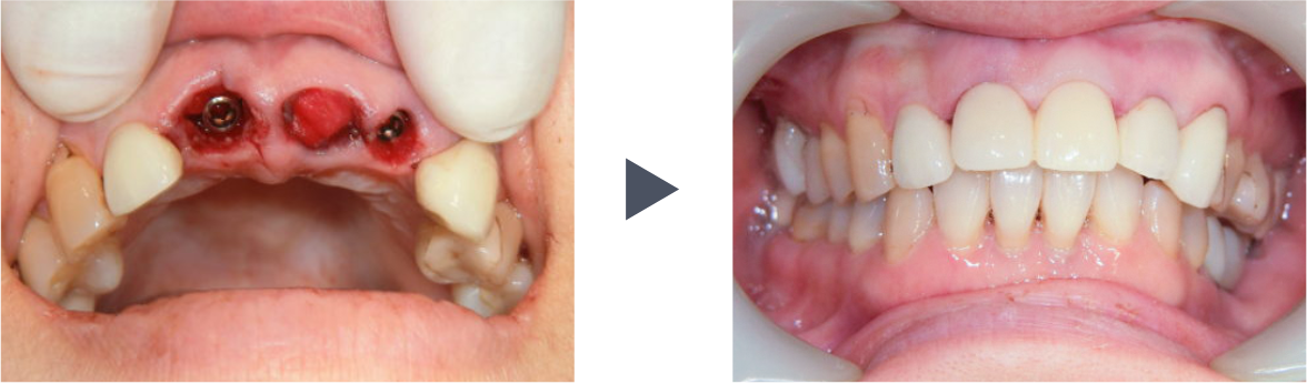 抜歯即時荷重インプラント