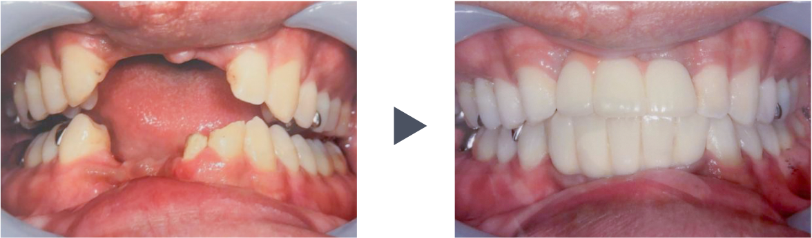 抜歯即時荷重インプラント