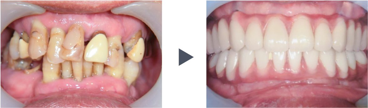 抜歯即時荷重インプラント