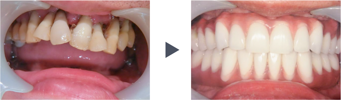 抜歯即時荷重インプラント